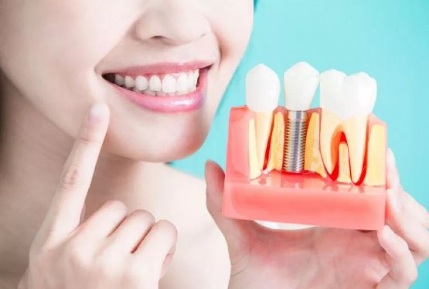Los implantes dentales no son un lujo